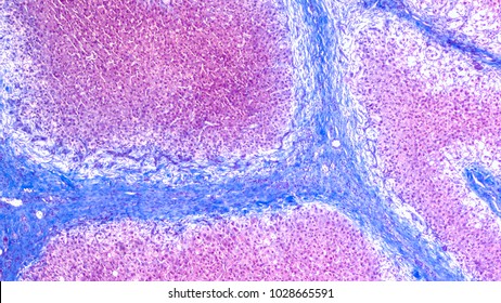 Photomicrograph of liver biopsy in a patient with cirrhosis, showing bridging septal fibrosis and regenerative nodules.  Stained with trichrome to highlight fibrosis  (blue).