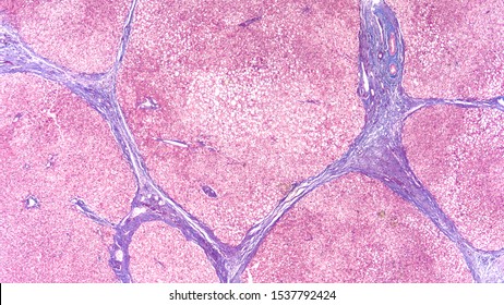 Photomicrograph Of Liver Biopsy In A Patient With Cirrhosis, Showing Bridging Septal Fibrosis And Regenerative Nodules.  Stained With Trichrome To Highlight Fibrosis  (blue).