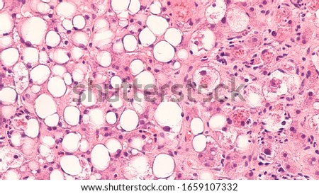 Photomicrograph of a liver core biopsy showing alcoholic liver disease with  fatty change (steatosis) on the left and Mallory bodies (Mallory hyaline) on the right. 