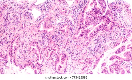 Photomicrograph Of Lung Biopsy Showing Pulmonary Adenocarcinoma, A Type Of Non Small Cell Carcinoma.