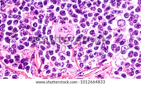 Photomicrograph of a lymph node in a patient with Hodgkin's Disease (lymphoma), showing a Reed Sternberg cell variant.