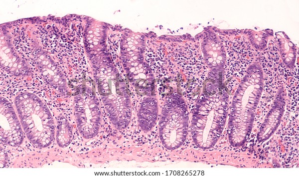 Photomicrograph Lymphocytic Colitis Type Microscopic Colitis Stock ...