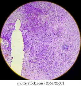 Photomicrograph of a malignant peripheral nerve sheath tumor (neurogenic sarcoma), a type of cancer derived from peripheral nerves - Shutterstock ID 2066725301