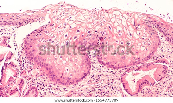 papilloma virus biopsy