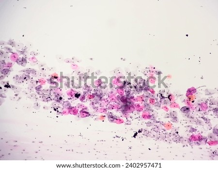Photomicrograph of Paps smear: Inflammatory smear with HPV related changes. Cervical cancer. SCC