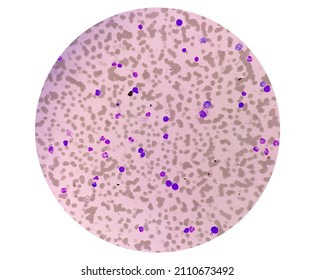 Photomicrograph Of Plasma Cell Leukemia (PCL) Or Waldenstrom Macroglobulinemia, A Rare Type Of Cancer That Begins In The White Blood Cells