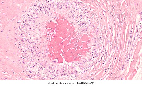 Photomicrograph Of A Rheumatoid Nodule, A Firm Lump That May Develop Under The Skin In Approximately A Quarter Of Patients With Rheumatoid Arthritis.  It Is A Type Of Necrobiotic Granuloma.  