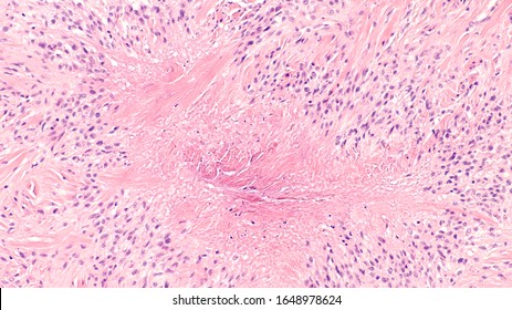 Photomicrograph Of A Rheumatoid Nodule, A Firm Lump That May Develop Under The Skin In Approximately A Quarter Of Patients With Rheumatoid Arthritis.  It Is A Type Of Necrobiotic Granuloma.  