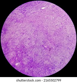 Photomicrograph Of A Schwannoma, A Benign Soft Tissue Tumor Of Peripheral Nerve Sheath.