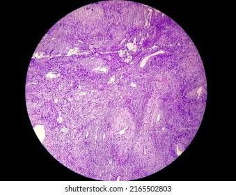 Photomicrograph Of A Schwannoma, A Benign Soft Tissue Tumor Of Peripheral Nerve Sheath.