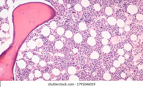 Photomicrograph Showing Histology A Bone Marrow Biopsy, With Cellular Hematopoietic Elements, Fatty Tissue And Bony Trabeculae.  