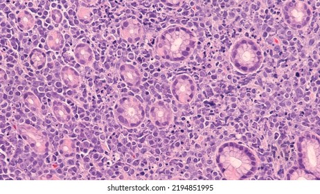 Photomicrograph showing pathology of Burkitt lymphoma, a rare but highly aggressive (fast-growing) B-cell non-Hodgkin lymphoma (NHL), involving colon.    - Shutterstock ID 2194851995