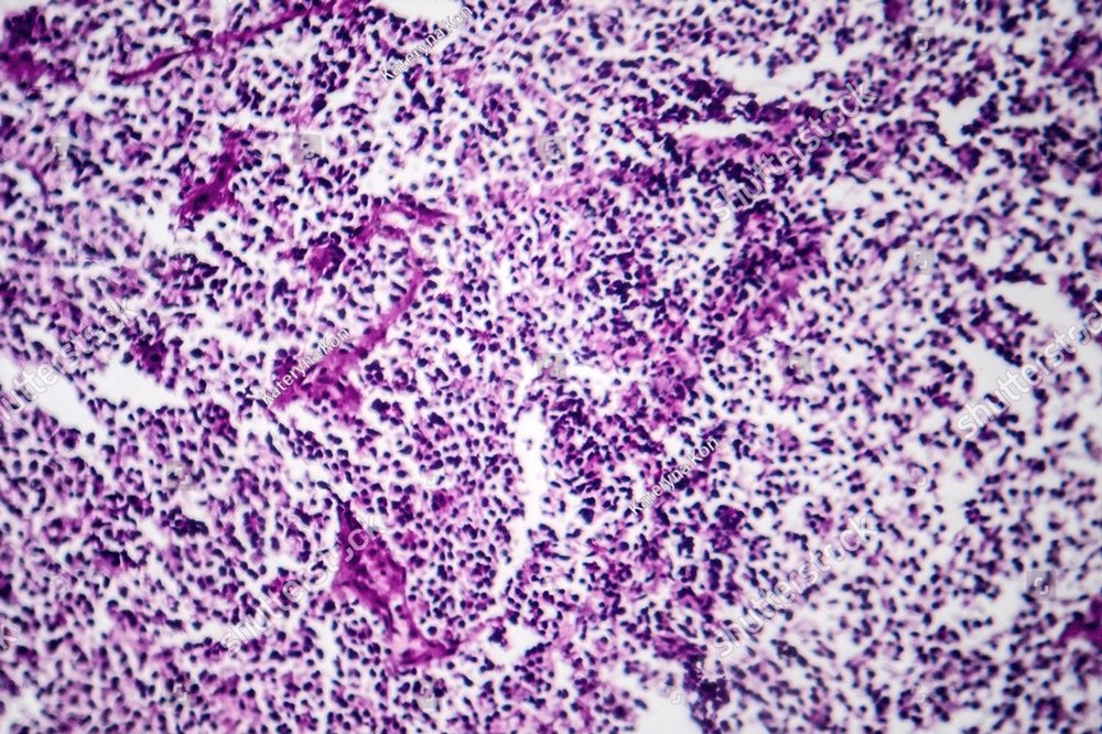 Photomicrograph of small cell lung cancer, revealing densely packed ...