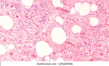 Photomicrograph Of A Spindle Cell Lipoma, A Type Of Lipoma With Spindle Cells.  