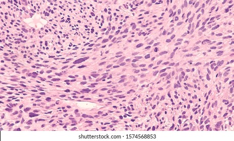 Photomicrograph Of A Spindle Cell Sarcoma, A Type Of Cancer Of Soft Tissue (connective Tissue).  The Malignant Cells Have The Shape Of A Spindle.