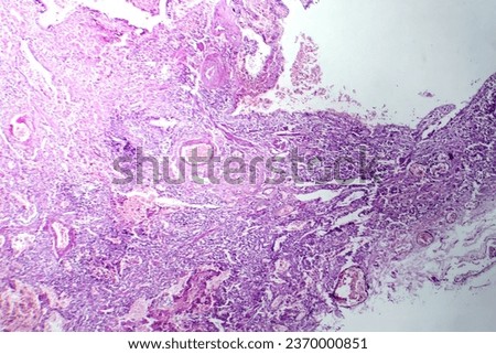 Photomicrograph of viral pneumonia, revealing inflammation and cellular damage caused by a viral respiratory infection.