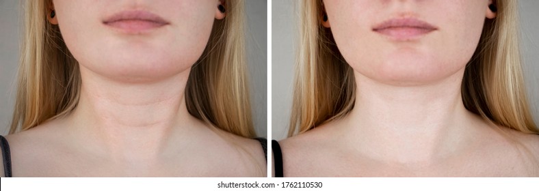 Fotos vor und nach der plastischen Chirurgie, um Venusringe zu entfernen. Kontrastmittel aus Nacken, Mesotherapie oder Botulintherapie. Falten und Falten im Nacken