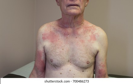 Photosensitivity Drug Reaction In An Elderly Male Resulting In A Hive Like Rash Over Sun Exposed Skin