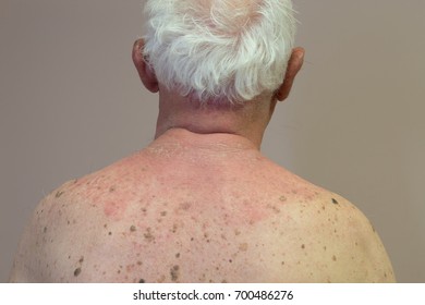 Photosensitivity Drug Reaction In An Elderly Male Resulting In A Hive Like Rash Over Sun Exposed Skin