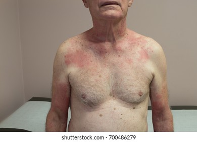 Photosensitivity Drug Reaction In An Elderly Male Resulting In A Hive Like Rash Over Sun Exposed Skin