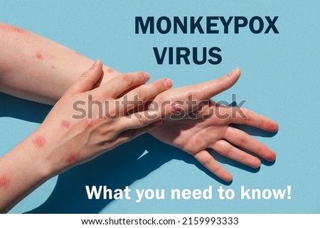 Phrase MONKEYPOX VIRUS what you need to know. Monkeypox new disease dangerous over the world. Patient with Monkey Pox. Painful rash, red spots blisters. Close up human hands with Health problem