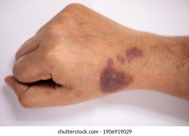 Das körperliche Aussehen des Arms mit der Wunde wird durch Hämophilie (Haemophiliais eine meist ererbte genetische Störung) verursacht.