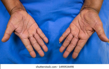 A Physical Of Atopic Dermatitis (AD ) Or Contact Dermatitis , Dry Hyper Pigmented  Peeling Cracked Plaque Skin Of Hand Of Asian Woman,also Known As Atopic Eczema, Is A Type Of Inflammation Of   