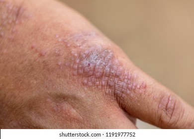 Physical Atopic Dermatitis Ad Known Atopic Stock Photo 1191977752 ...