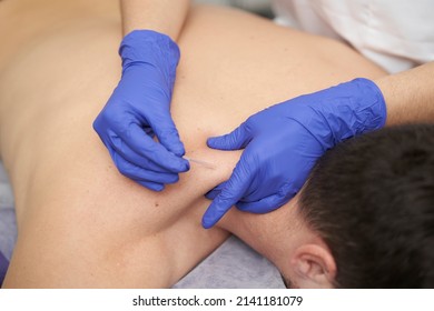 physiotherapist treating an overload with dry needling