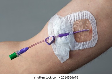 Picc (Peripherally Inserted Central Catheter) In The Arm Of A Man - Shutterstock ID 2014586678