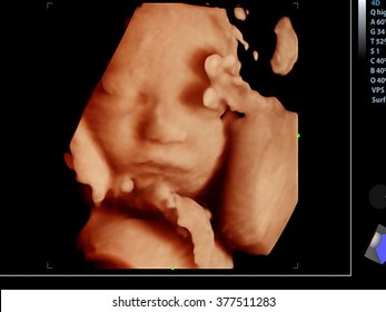 Picture 4D Ultrasound of baby in mother's womb.show the face.
