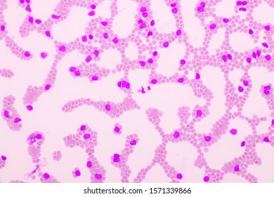 Picture Acute Lymphocytic Leukemia All Cells Stock Photo (Edit Now ...