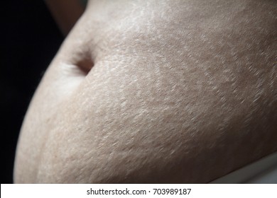 Picture Of Belly After Giving Birth,stretchmarks,belly Button Scar,wrinkle,pigmentation,pregnancy Pouch And  A Dark Line Down Their Abdomen.   