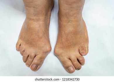 Picture Bilateral Forefeet Deformity Black White Stock Photo 1218342730 ...