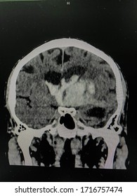 The Picture Of Brain Computed Tomography Of A Human That Have Intracerebral Hemorrhage And Intraventricular Hemorrhage At Right Thalamus ,Medical Technology And Science Concept.colonal View.