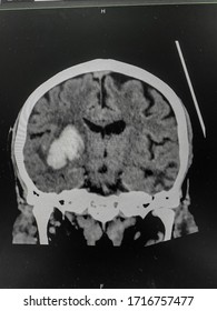 The Picture Of Brain Computed Tomography Of A Human That Have Intracerebral Hemorrhage And Intraventricular Hemorrhage At Right Thalamus ,Medical Technology And Science Concept.colonal View.