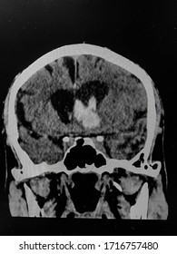 The Picture Of Brain Computed Tomography Of A Human That Have Intracerebral Hemorrhage And Intraventricular Hemorrhage At Right Thalamus ,Medical Technology And Science Concept.colonal View.