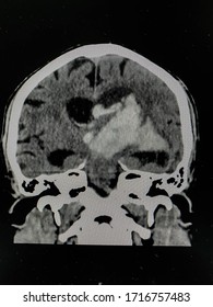 The Picture Of Brain Computed Tomography Of A Human That Have Intracerebral Hemorrhage And Intraventricular Hemorrhage At Right Thalamus ,Medical Technology And Science Concept.colonal View.