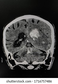 The Picture Of Brain Computed Tomography Of A Human That Have Intracerebral Hemorrhage And Intraventricular Hemorrhage At Right Thalamus ,Medical Technology And Science Concept.colonal View.