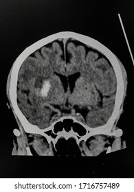 The Picture Of Brain Computed Tomography Of A Human That Have Intracerebral Hemorrhage And Intraventricular Hemorrhage At Right Thalamus ,Medical Technology And Science Concept.colonal View.