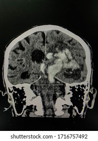 The Picture Of Brain Computed Tomography Of A Human That Have Intracerebral Hemorrhage And Intraventricular Hemorrhage At Right Thalamus ,Medical Technology And Science Concept.colonal View.