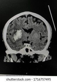 The Picture Of Brain Computed Tomography Of A Human That Have Intracerebral Hemorrhage And Intraventricular Hemorrhage At Right Thalamus ,Medical Technology And Science Concept.colonal View.