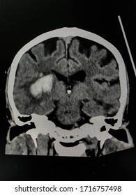 The Picture Of Brain Computed Tomography Of A Human That Have Intracerebral Hemorrhage And Intraventricular Hemorrhage At Right Thalamus ,Medical Technology And Science Concept.colonal View.