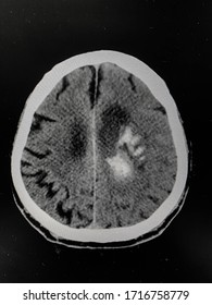 The Picture Of Brain Computed Tomography Of A Human That Have Intracerebral Hemorrhage And Intraventricular Hemorrhage At Left Thalamus ,Medical Technology And Science Concept. Horizontal View.
