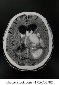 The Picture Of Brain Computed Tomography Of A Human That Have Intracerebral Hemorrhage And Intraventricular Hemorrhage At Left Thalamus ,Medical Technology And Science Concept. Horizontal View.
