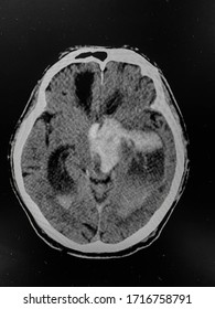 The Picture Of Brain Computed Tomography Of A Human That Have Intracerebral Hemorrhage And Intraventricular Hemorrhage At Left Thalamus ,Medical Technology And Science Concept. Horizontal View.
