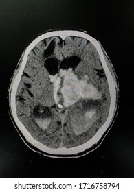 The Picture Of Brain Computed Tomography Of A Human That Have Intracerebral Hemorrhage And Intraventricular Hemorrhage At Left Thalamus ,Medical Technology And Science Concept. Horizontal View.
