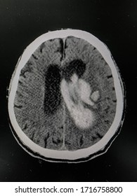 The Picture Of Brain Computed Tomography Of A Human That Have Intracerebral Hemorrhage And Intraventricular Hemorrhage At Left Thalamus ,Medical Technology And Science Concept. Horizontal View.
