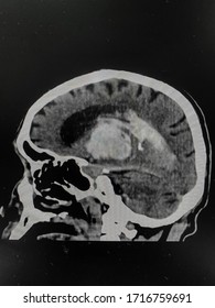 The Picture Of Brain Computed Tomography Of A Human That Have Intracerebral Hemorrhage And Intraventricular Hemorrhage At Left Thalamus ,Medical Technology And Science Concept. Sagittal View.
