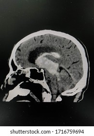 The Picture Of Brain Computed Tomography Of A Human That Have Intracerebral Hemorrhage And Intraventricular Hemorrhage At Left Thalamus ,Medical Technology And Science Concept. Sagittal View.
